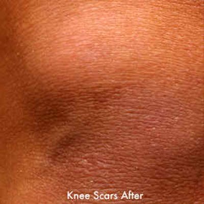 Laser Scar Treatments Before & After Gallery - Patient 37499701 - Image 2