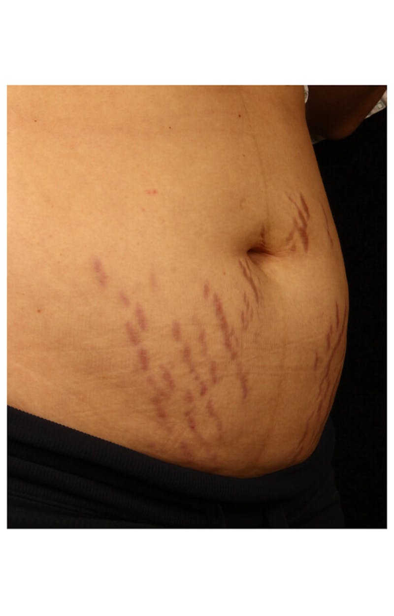 Stretchmarks Before & After Gallery - Patient 37499709 - Image 1