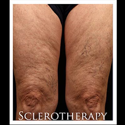 Spider Veins Before & After Gallery - Patient 37499710 - Image 1
