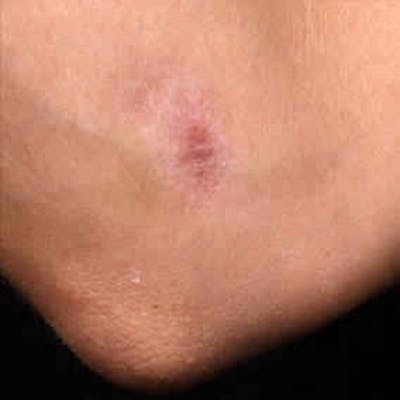 Laser Scar Treatments Before & After Gallery - Patient 37499712 - Image 1