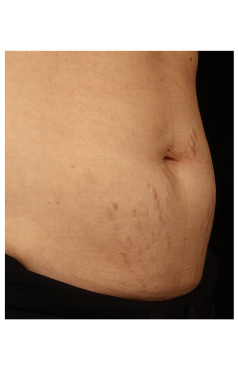 Stretchmarks Before & After Gallery - Patient 37499709 - Image 2