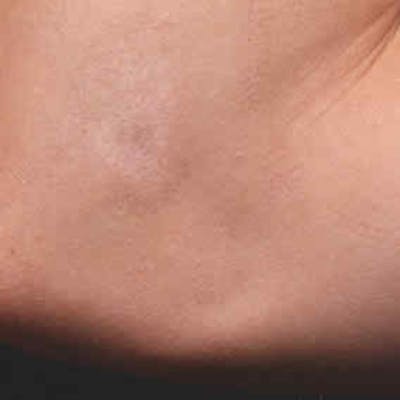 Laser Scar Treatments Before & After Gallery - Patient 37499712 - Image 2