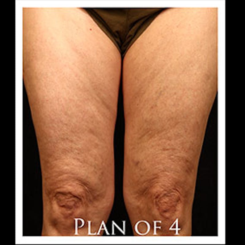 Spider Veins Before & After Gallery - Patient 37499710 - Image 2