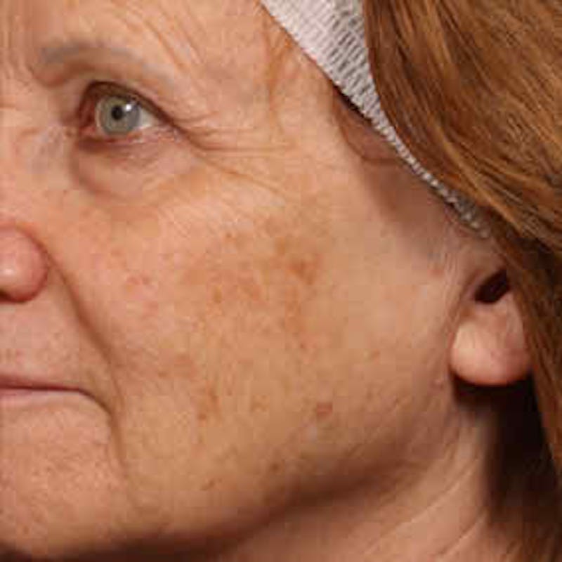 Pigmented Lesion Laser Treatment Before & After Gallery - Patient 37499719 - Image 1