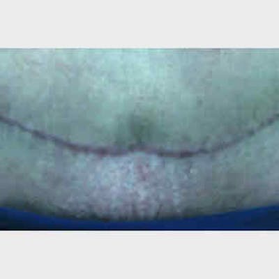 Laser Scar Treatments Before & After Gallery - Patient 37499720 - Image 1