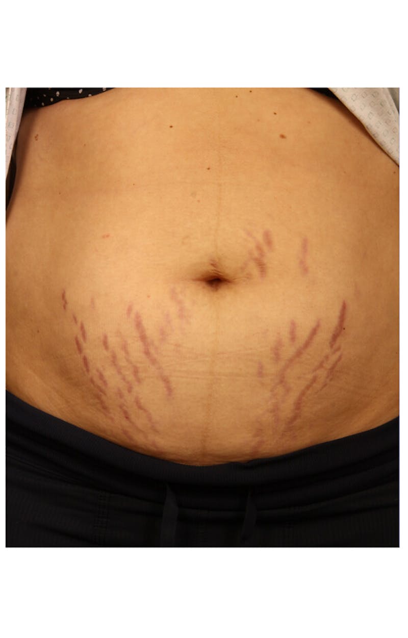 Stretchmarks Before & After Gallery - Patient 37499724 - Image 1