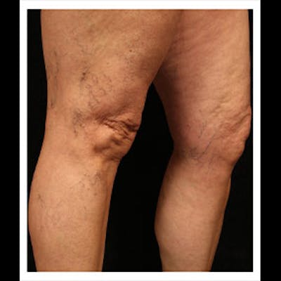 Spider Veins Before & After Gallery - Patient 37499722 - Image 1