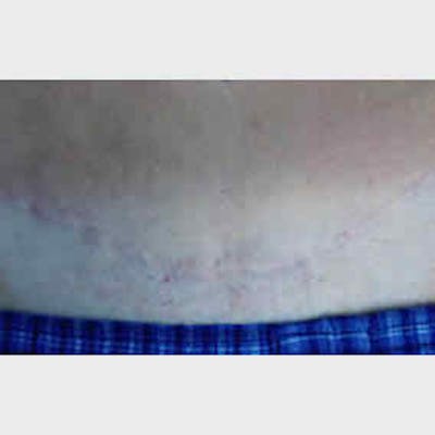 Laser Scar Treatments Before & After Gallery - Patient 37499720 - Image 2