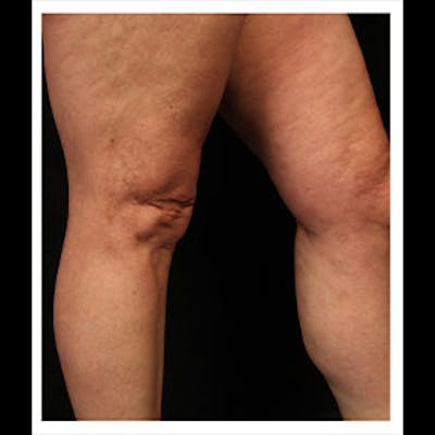 Spider Veins Before & After Gallery - Patient 37499722 - Image 2