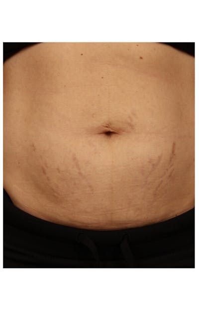 Stretchmarks Before & After Gallery - Patient 37499724 - Image 2