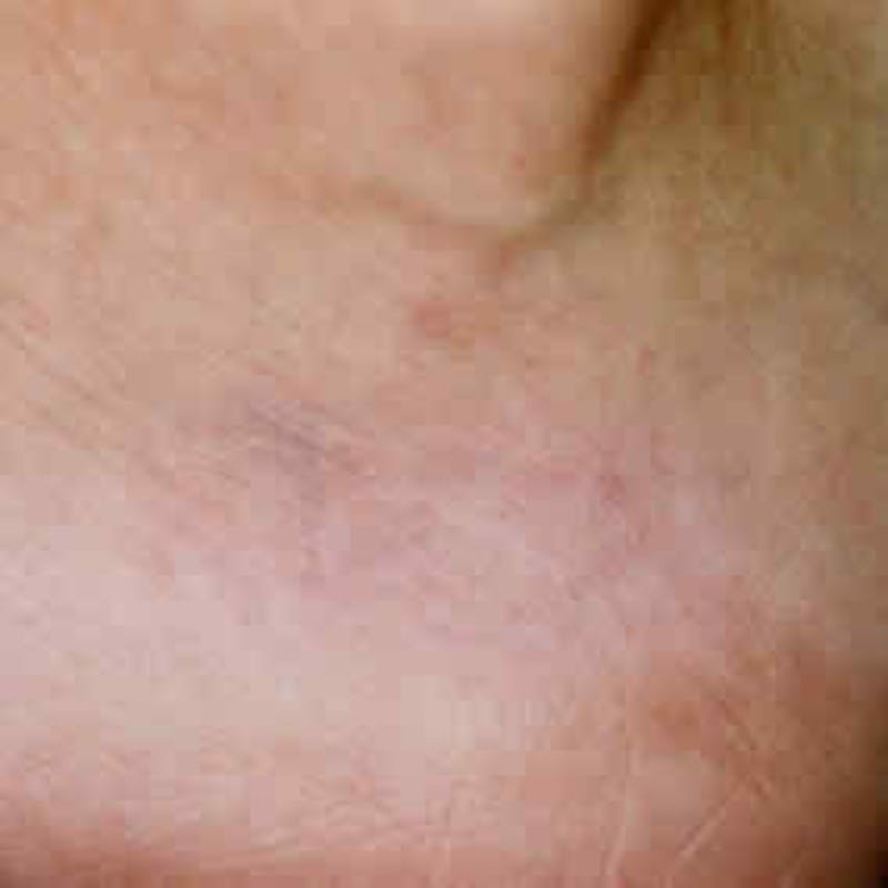 Laser Tattoo Removal Before & After Gallery - Patient 37499723 - Image 2
