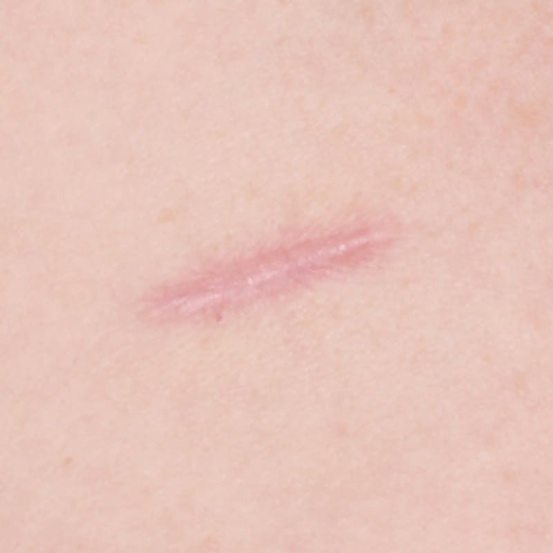 Laser Scar Treatments Before & After Gallery - Patient 37499732 - Image 1
