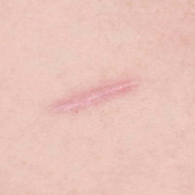 Laser Scar Treatments Before & After Gallery - Patient 37499732 - Image 1