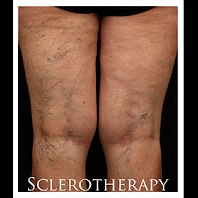 Spider Veins Before & After Gallery - Patient 37499733 - Image 1