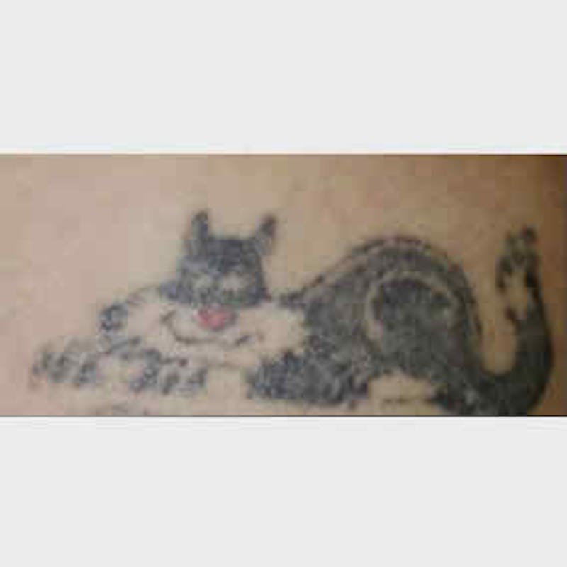Laser Tattoo Removal Before & After Gallery - Patient 37499734 - Image 1