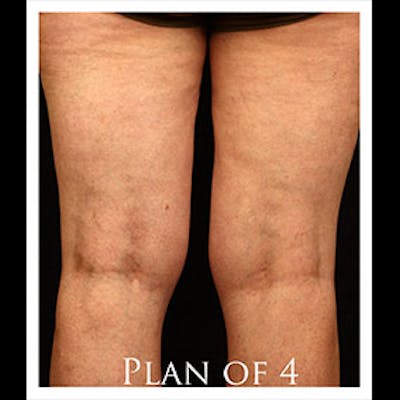 Spider Veins Before & After Gallery - Patient 37499733 - Image 2