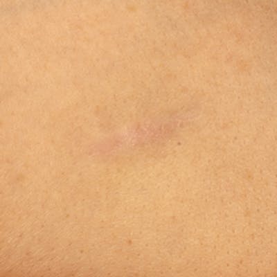 Laser Scar Treatments Before & After Gallery - Patient 37499732 - Image 2