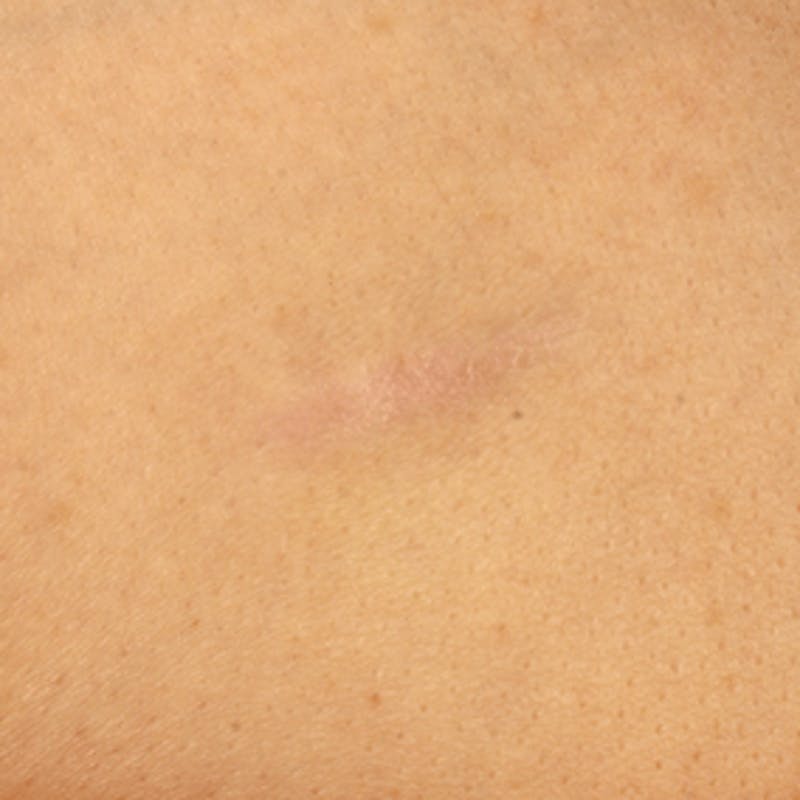 Laser Scar Treatments Before & After Gallery - Patient 37499732 - Image 2