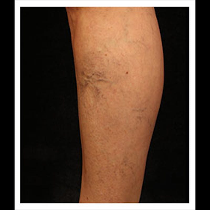 Spider Veins Before & After Gallery - Patient 37499742 - Image 1