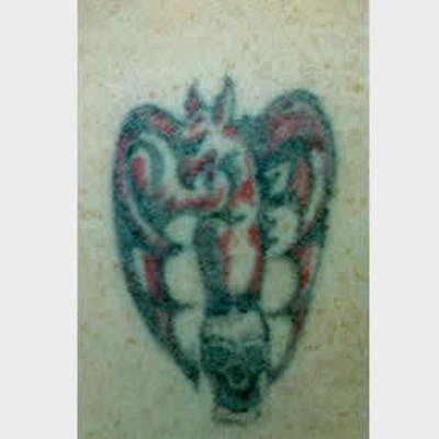 Laser Tattoo Removal Before & After Gallery - Patient 37499743 - Image 1