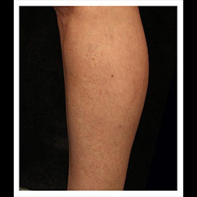 Spider Veins Before & After Gallery - Patient 37499742 - Image 2