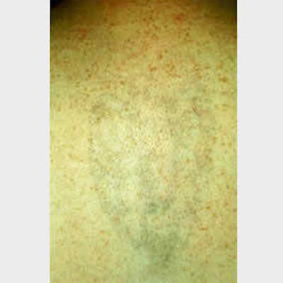 Laser Tattoo Removal Before & After Gallery - Patient 37499743 - Image 2