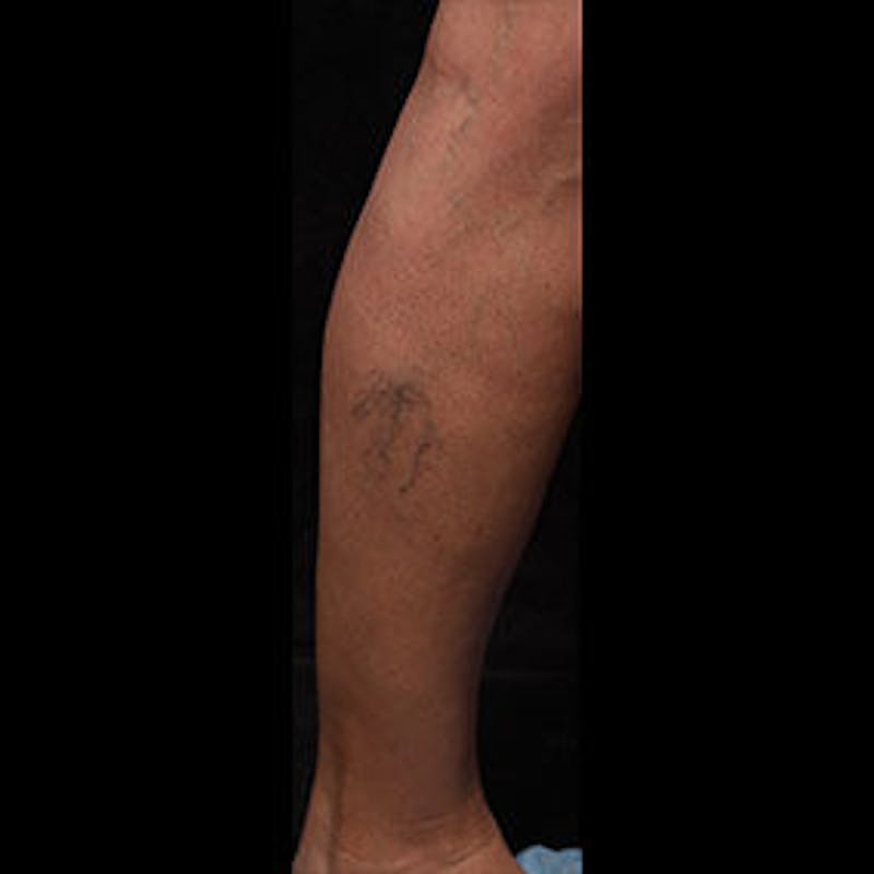 Spider Veins Before & After Gallery - Patient 37499751 - Image 1