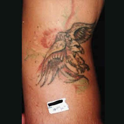 Laser Tattoo Removal Before & After Gallery - Patient 37499752 - Image 1