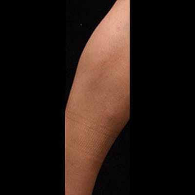Spider Veins Before & After Gallery - Patient 37499751 - Image 2