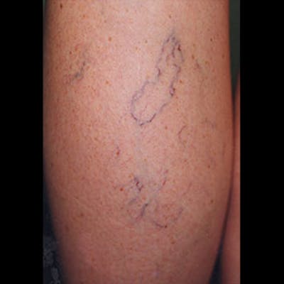 Spider Veins Before & After Gallery - Patient 37499759 - Image 1