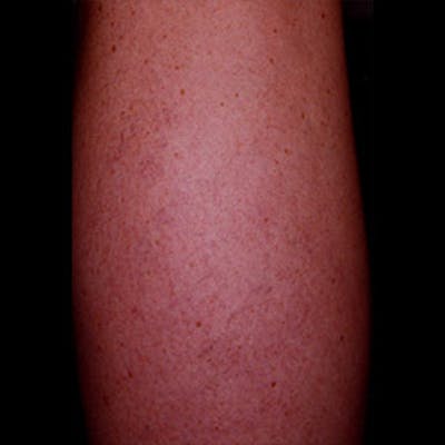 Spider Veins Before & After Gallery - Patient 37499759 - Image 2