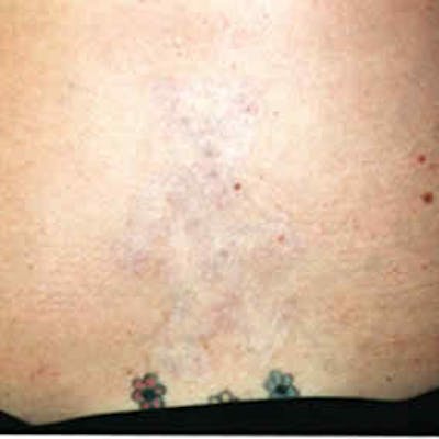 Laser Tattoo Removal Before & After Gallery - Patient 37499761 - Image 2