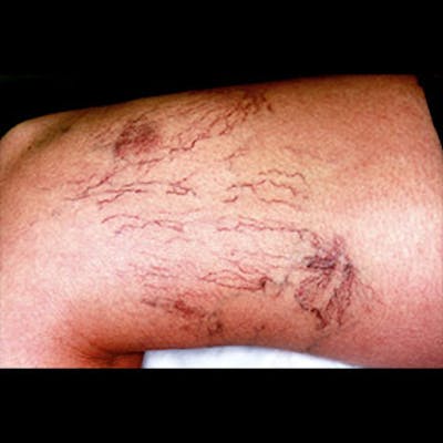 Spider Veins Before & After Gallery - Patient 37499768 - Image 1