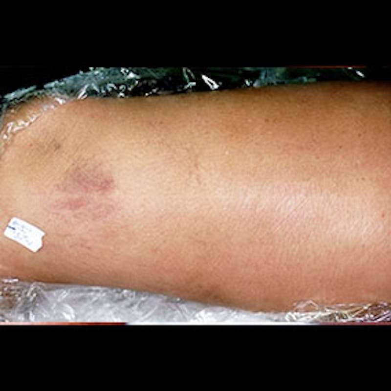 Spider Veins Before & After Gallery - Patient 37499768 - Image 2