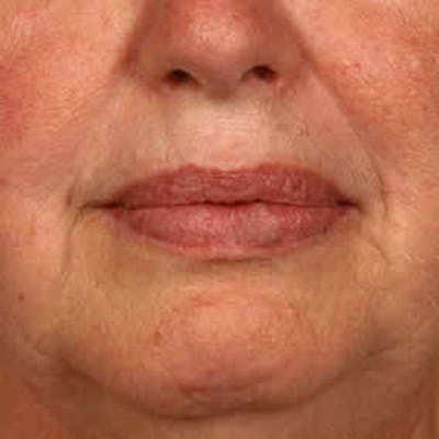 Vascular Lesion Laser Treatment Before & After Gallery - Patient 37504787 - Image 2