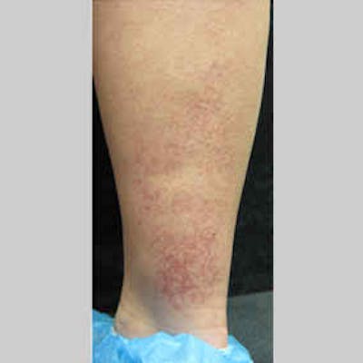 Vascular Lesion Laser Treatment Before & After Gallery - Patient 37504791 - Image 1