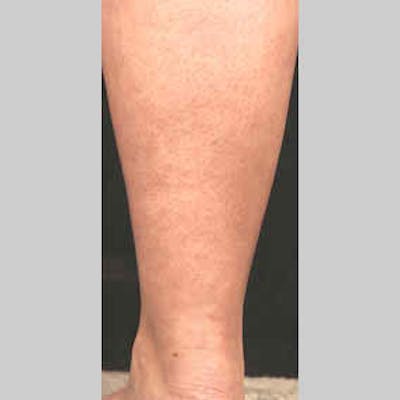 Vascular Lesion Laser Treatment Before & After Gallery - Patient 37504791 - Image 2
