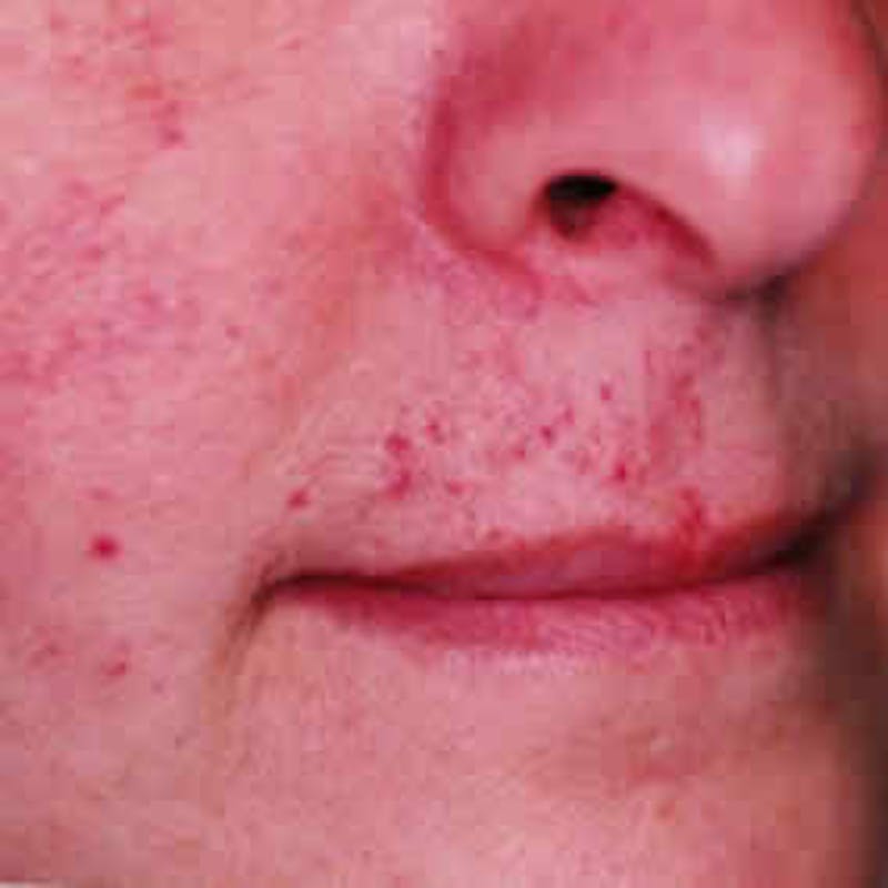 Vascular Lesion Laser Treatment Before & After Gallery - Patient 37504797 - Image 1