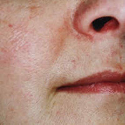 Vascular Lesion Laser Treatment Before & After Gallery - Patient 37504797 - Image 2