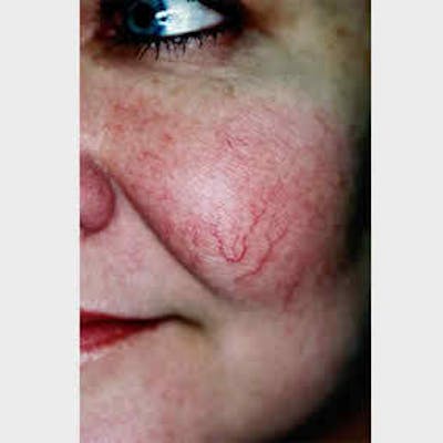 Vascular Lesion Laser Treatment Before & After Gallery - Patient 37504803 - Image 1