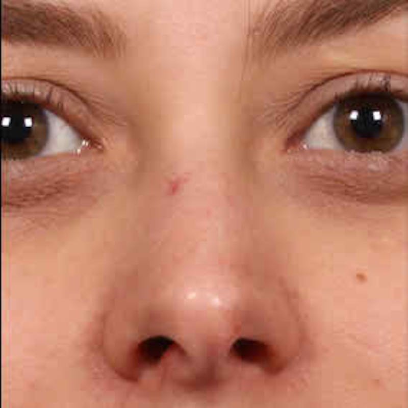 Vascular Lesion Laser Treatment Before & After Gallery - Patient 37504805 - Image 1
