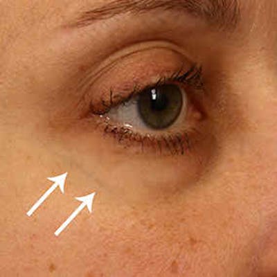 Vascular Lesion Laser Treatment Before & After Gallery - Patient 37504807 - Image 1
