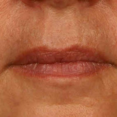 Vascular Lesion Laser Treatment Before & After Gallery - Patient 37504815 - Image 2