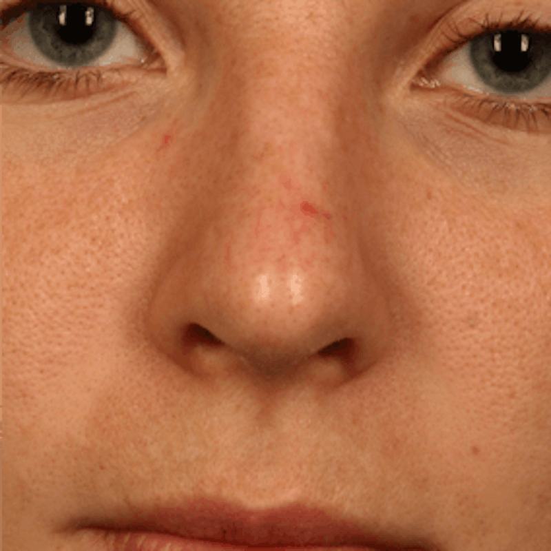 Vascular Lesion Laser Treatment Before & After Gallery - Patient 37504817 - Image 1