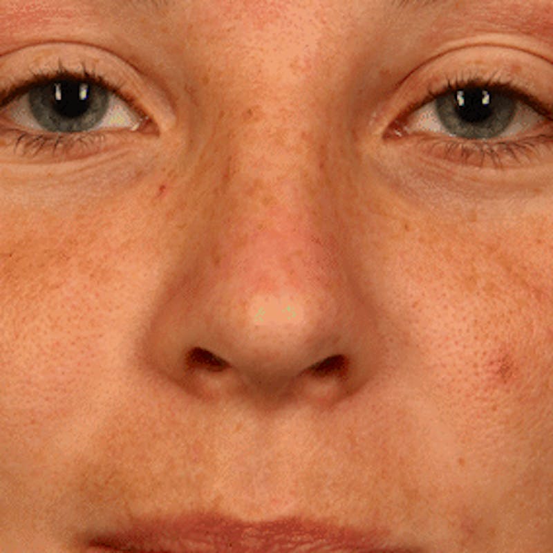 Vascular Lesion Laser Treatment Before & After Gallery - Patient 37504817 - Image 2
