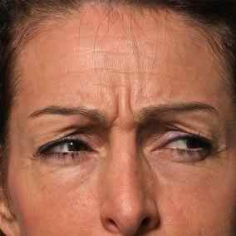 BOTOX, Dysport, Jeuveau, Xeomin Before & After Gallery - Patient 37504827 - Image 1