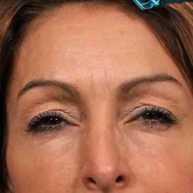 BOTOX, Dysport, Jeuveau, Xeomin Before & After Gallery - Patient 37504827 - Image 2