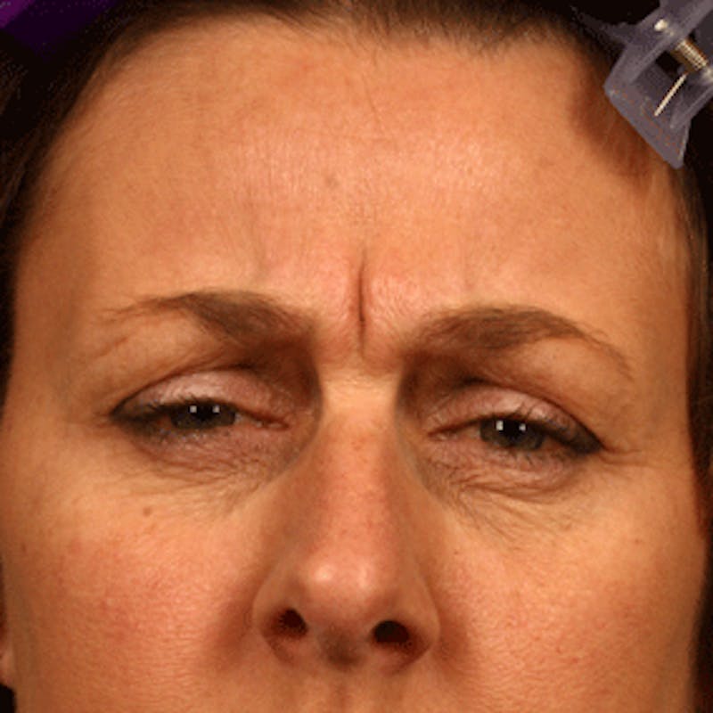 BOTOX, Dysport, Jeuveau, Xeomin Before & After Gallery - Patient 37504833 - Image 1
