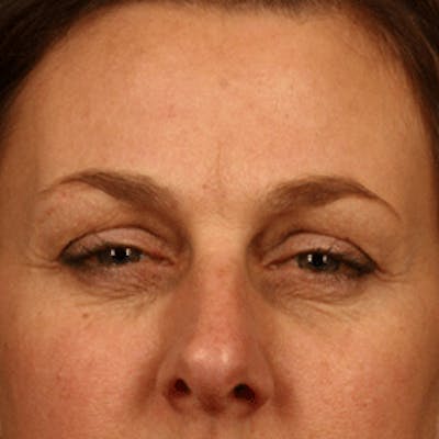BOTOX, Dysport, Jeuveau, Xeomin Before & After Gallery - Patient 37504833 - Image 2
