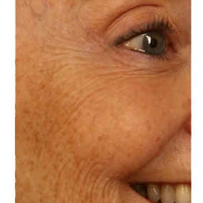 BOTOX, Dysport, Jeuveau, Xeomin Before & After Gallery - Patient 37504835 - Image 1